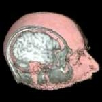 MRI: A Window on the Human Body - Laurie Hall, Cambridge University